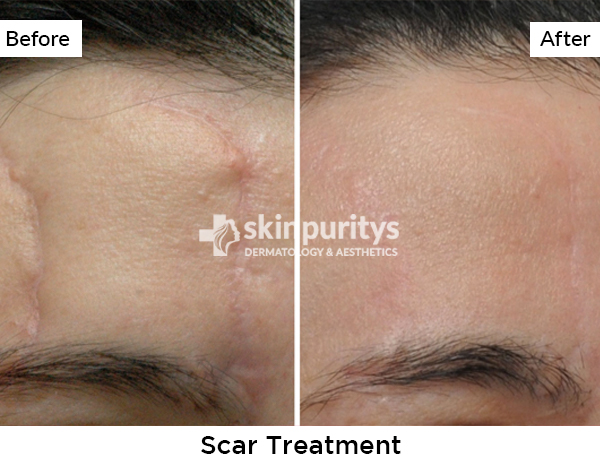 Scars results